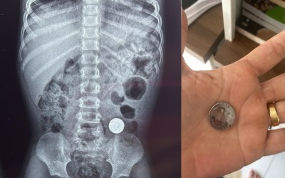 Criança de 3 anos engole bateria de lítio e é internada com dor abdominal em RO